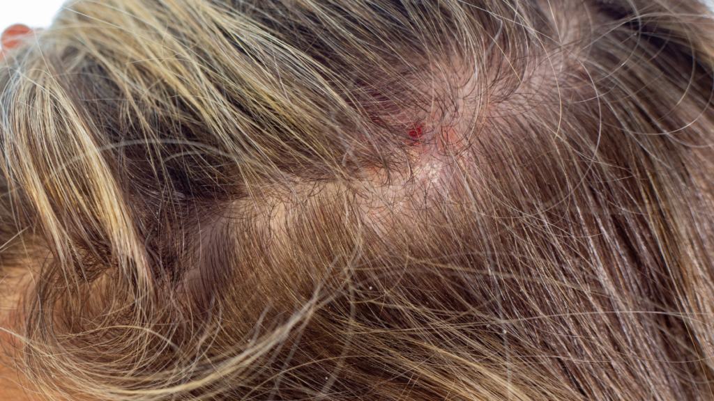 demodex on the scalp. Close-up of scalp with irritation