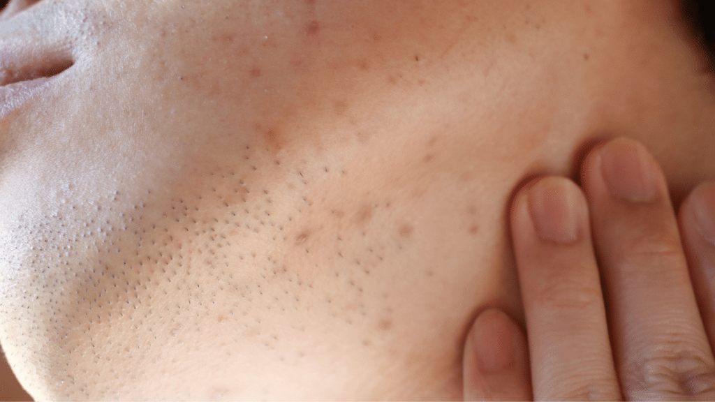 Demodex and hormonal acne presentation showing jawline papulopustular lesions on adult female skin