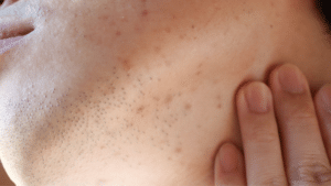 Demodex and hormonal acne presentation showing jawline papulopustular lesions on adult female skin