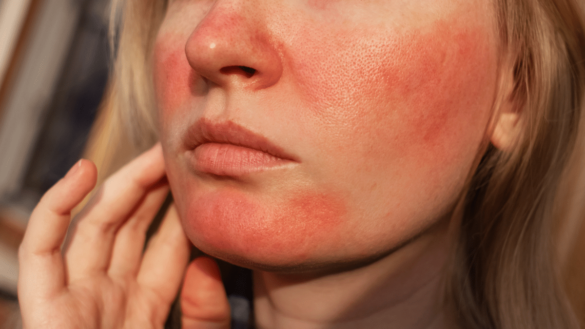 Demodex and Hashimoto's clinical presentation showing facial inflammation and papulopustular rosacea-like lesions in an autoimmune thyroid patient