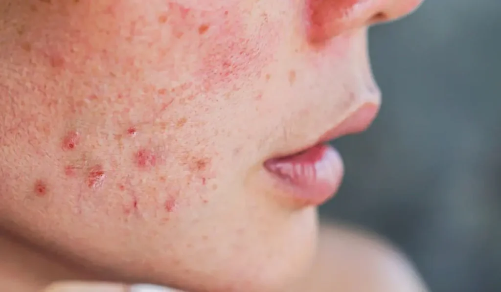 Demodex Infestation under microscope