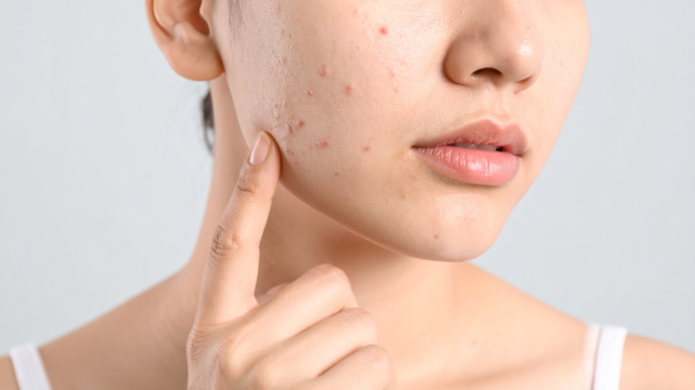 demodex die-off rosacea acne