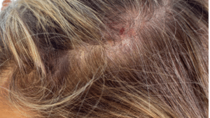 Close-up of irritated scalp with red bumps near the hairline, showing possible scalp folliculitis, demodex-related inflammation, or clogged hair follicles.