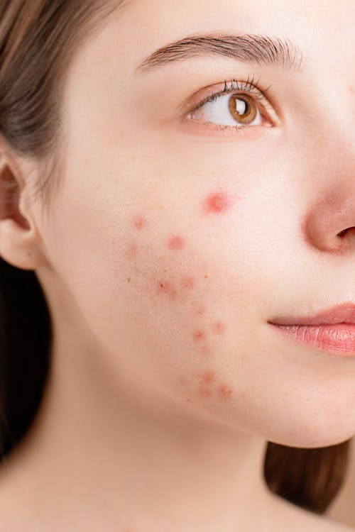 Natural Remedies for Demodex Mites