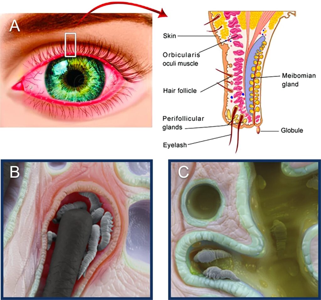Demodex Chalazion 