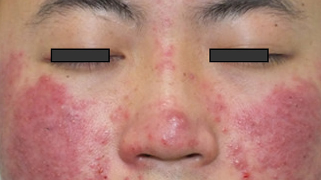 Demodex Back Folliculitis