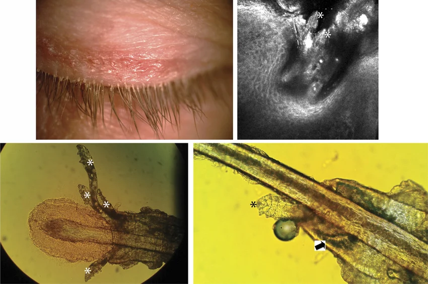 Demodex Chalazion 
