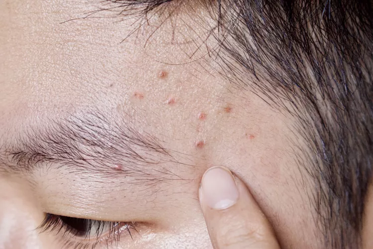 Demodex Back Folliculitis