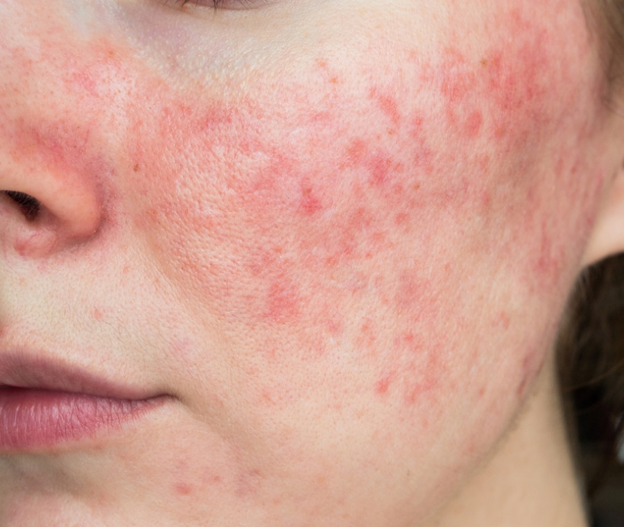 Demodex and Candida