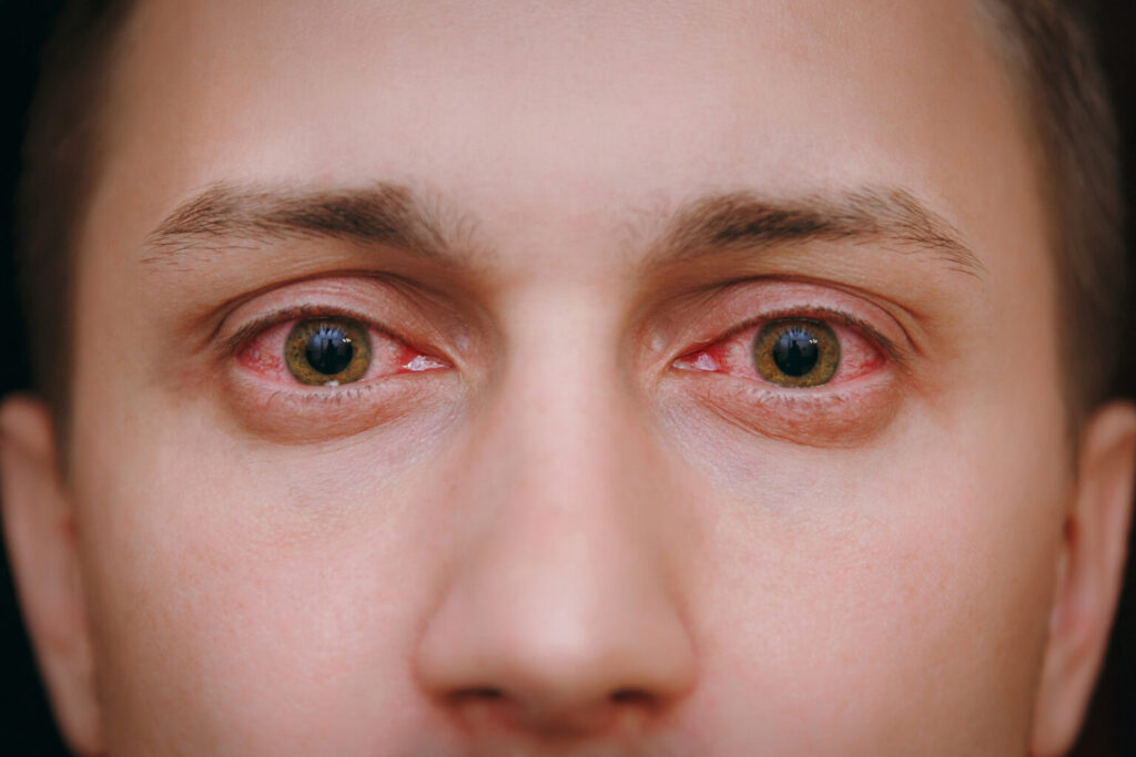 Red, irritated eyes associated with dry eye disease, blepharitis, and Demodex infestation