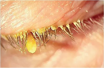 Demodex and Collarettes