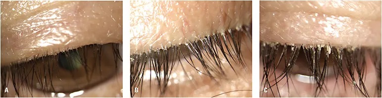 Demodex and Collarettes