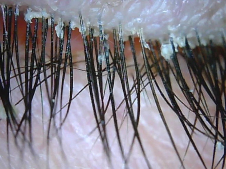 Demodex and Collarettes on Eyelashes
