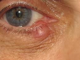 Demodex Chalazion 