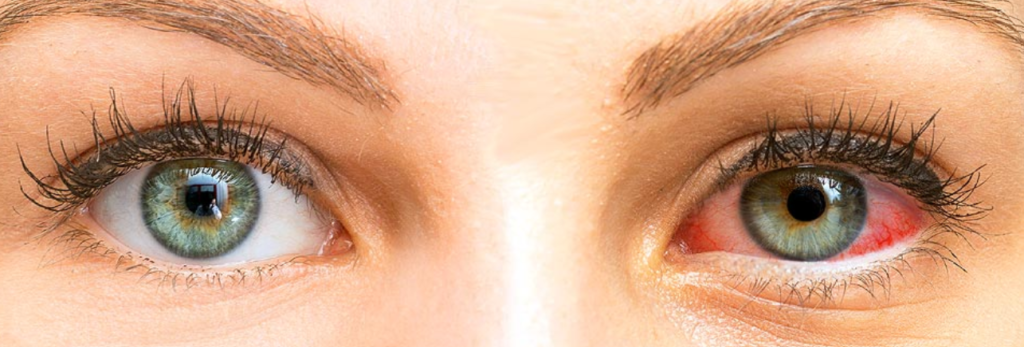 Demodex and Dry Eye
